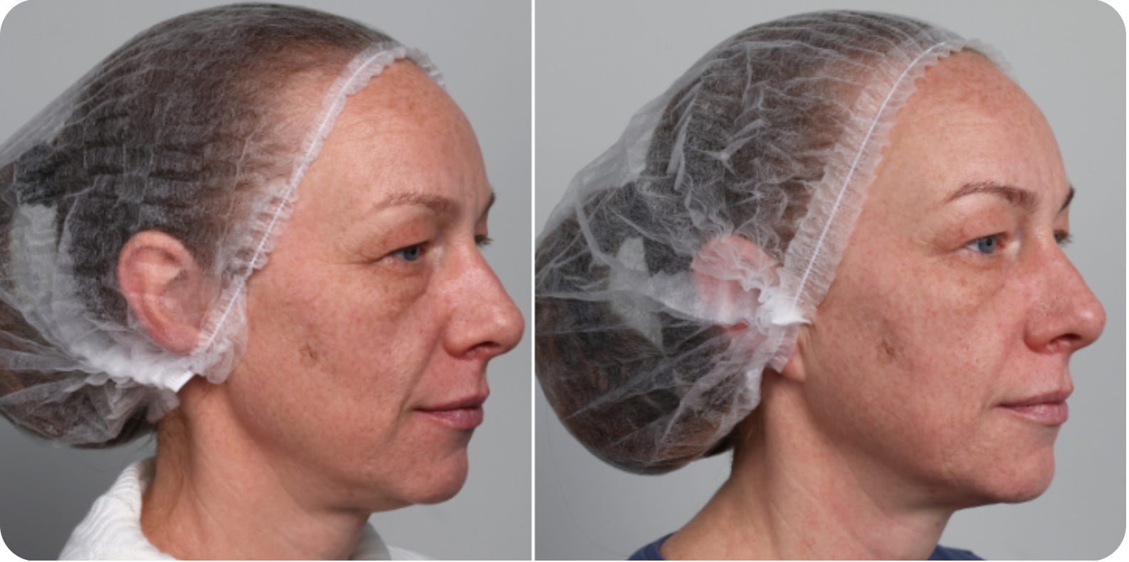 Подтяжка лица. 5 процедур