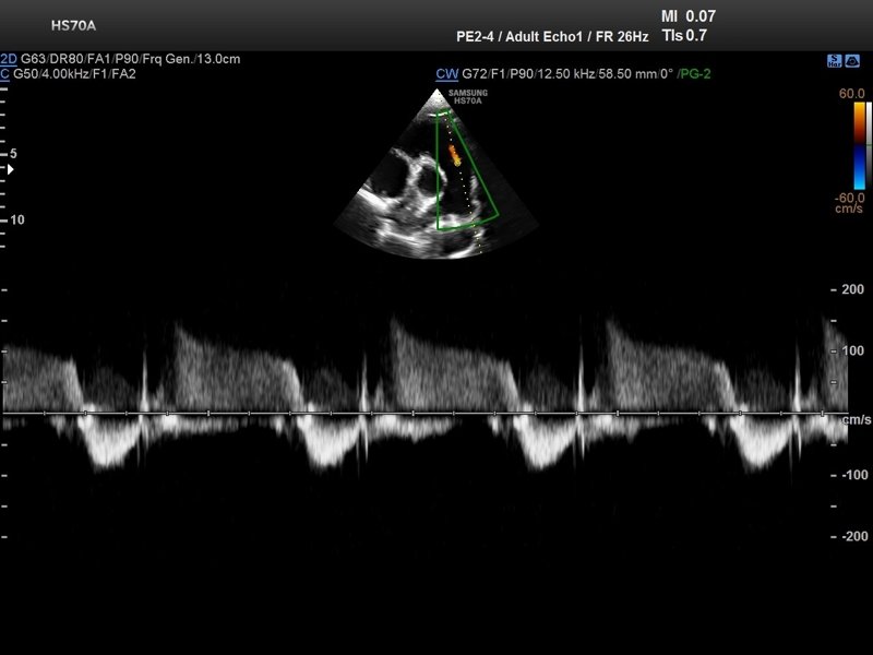 Визуализация сердечной мышцы в триплексном режиме (В-режим + ЦДК + CW-допплер)