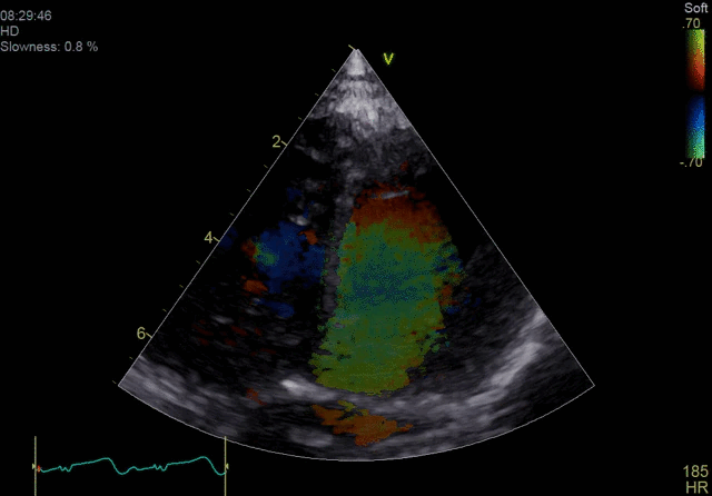 Недоплеровская визуализация кровотока (BSI)