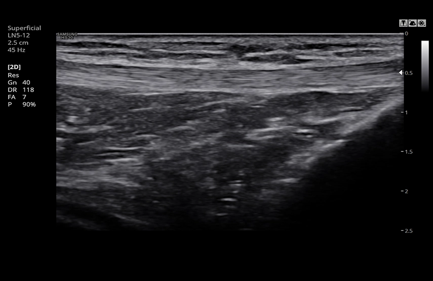 Колено в ClearVision