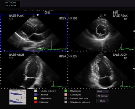 Автоматическое оконтуривание допплеровского спектра в реальном времени с быстрым расчётом параметров гемодинамики