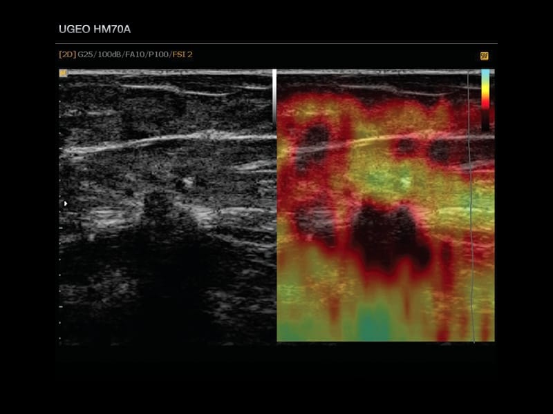 Молочная железа, эластография