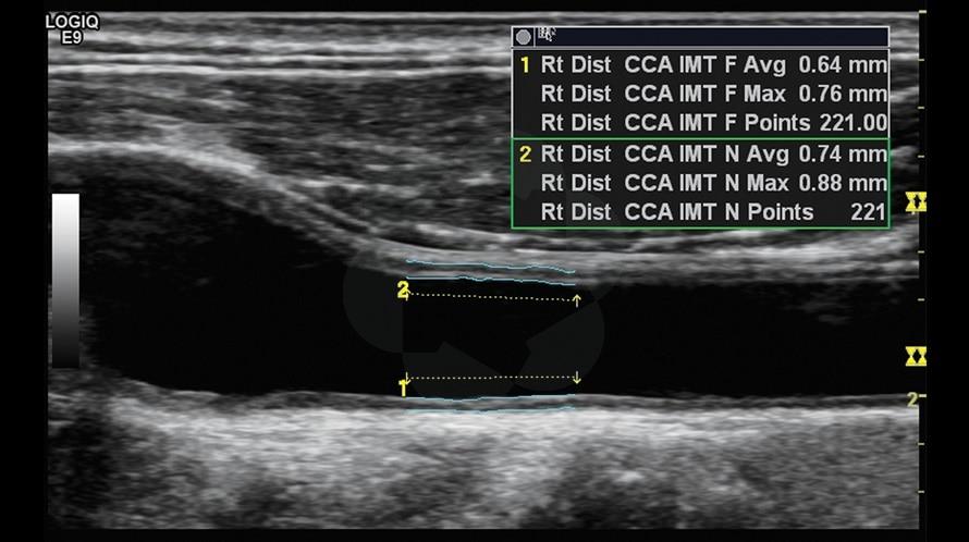 Автоматическое измерение IMT