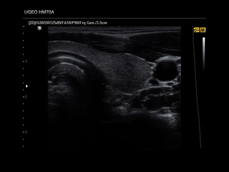 Щитовидная железа, правая доля