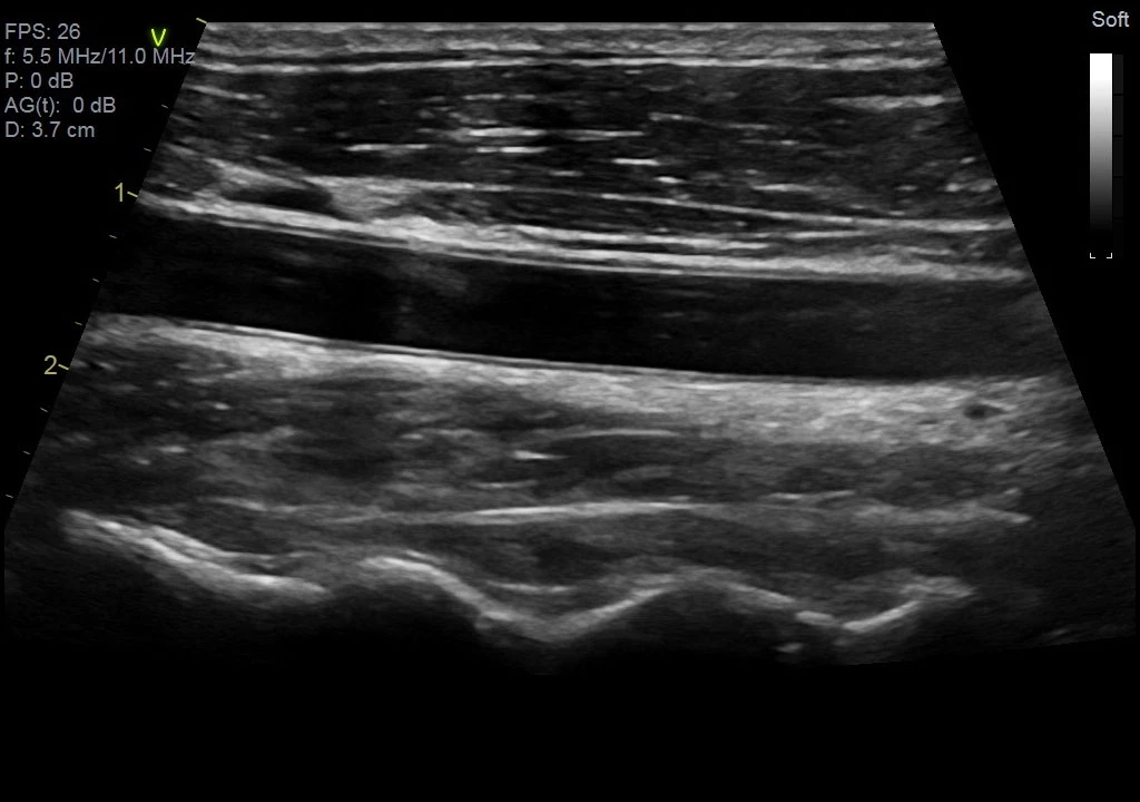 Виртуальный конвекс, датчик 11L-D