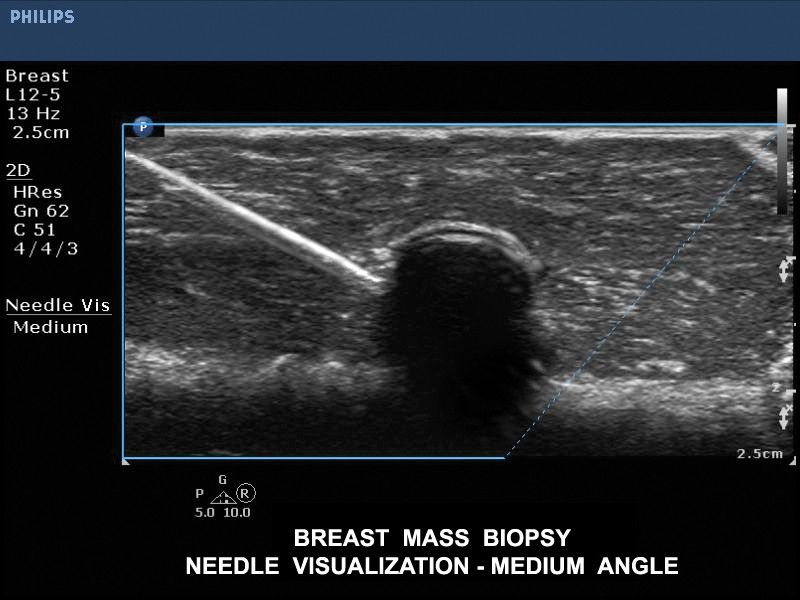 Визуализация иглы при биопсии молочной железы, датчик L12-5