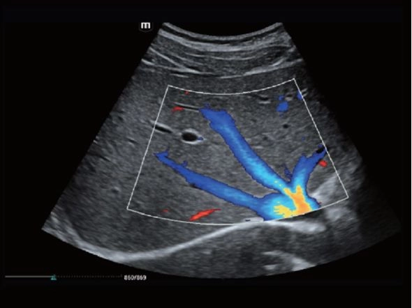 Сонная артерия и яремная вена