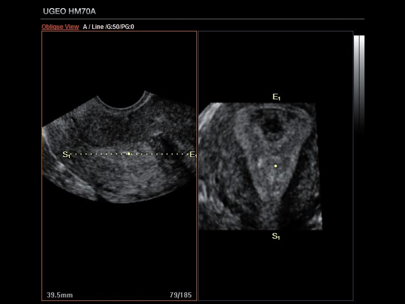 Матка, Oblique View