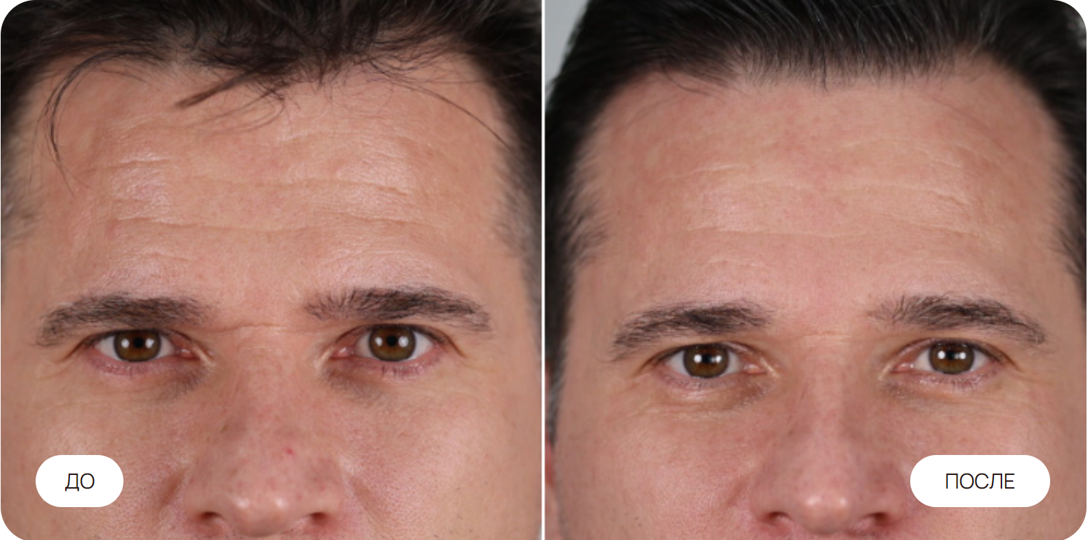 Уменьшение глубины морщин. 10 процедур