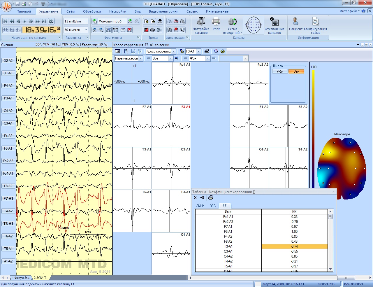 Энцефалан-ЭЭГР-19/26. Основная модификация - изображение №9
