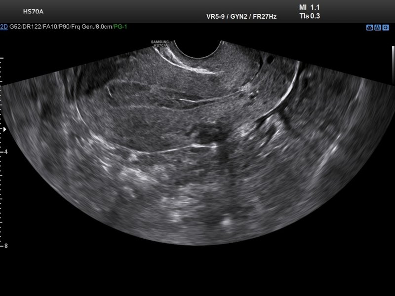 Визуализация матки в В-режиме