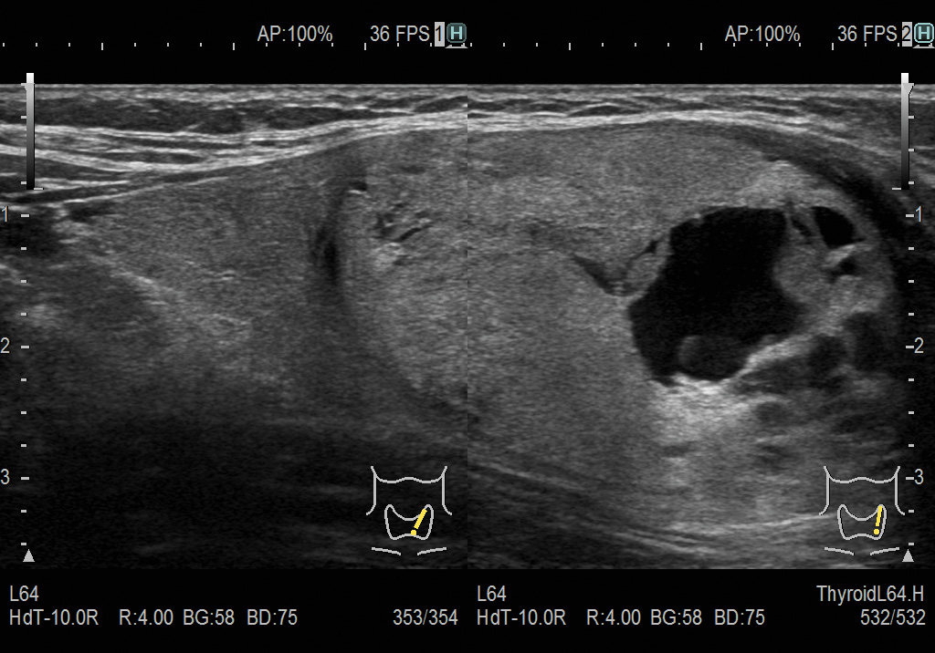 Образование в щитовидной железе. Визуализация на двойном экране в режиме eFocusing