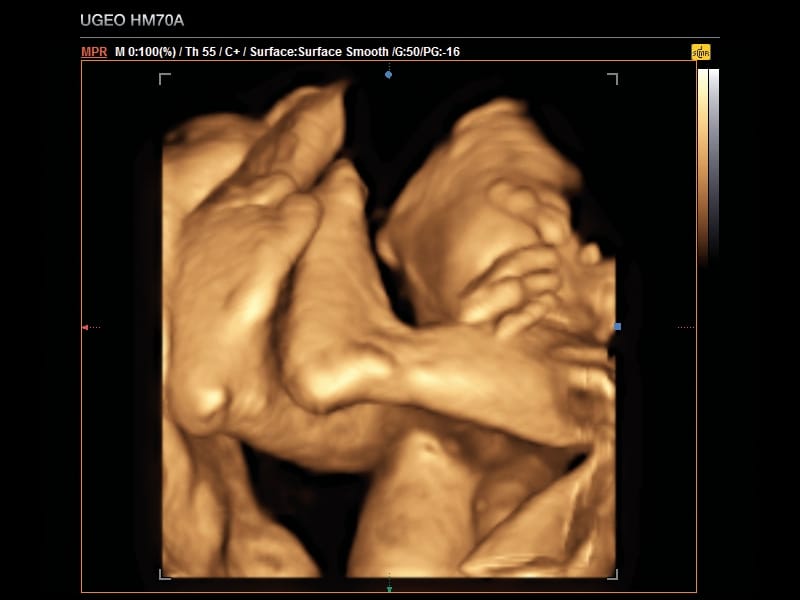 Плод, нижние конечности, 3D