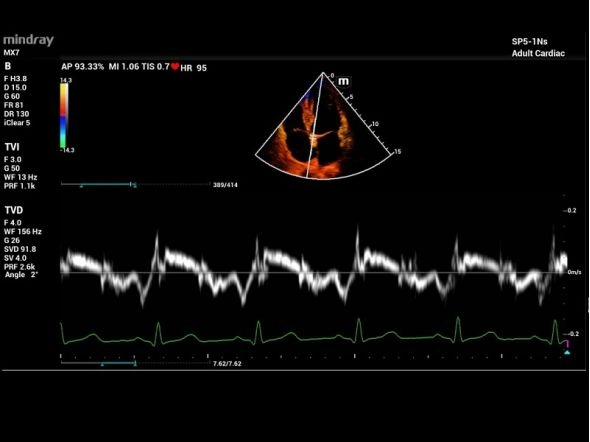 Исследование сердца взрослого TDI
