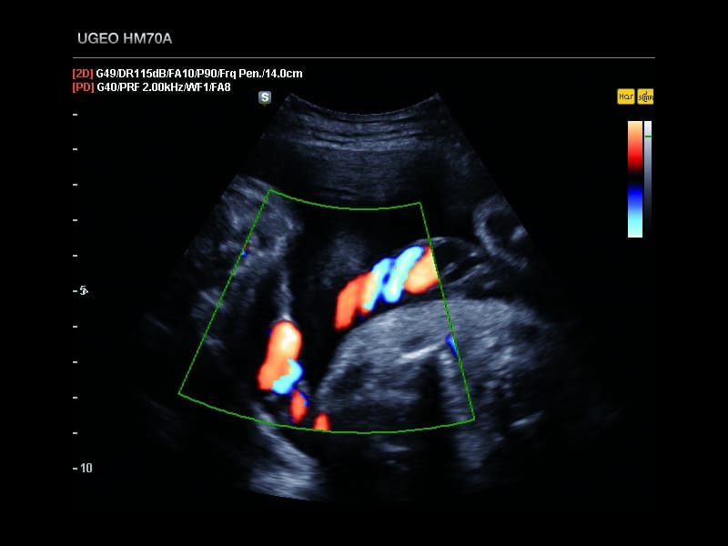Плод, пуповина, S-Flow