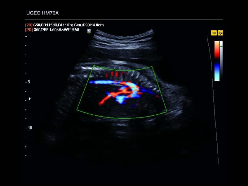 Плод, дуга, аорты, S-Flow