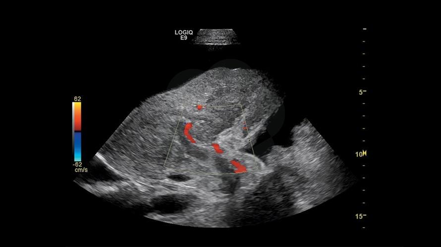 Портативный тромбоз вен и патентованная печеночная артерия