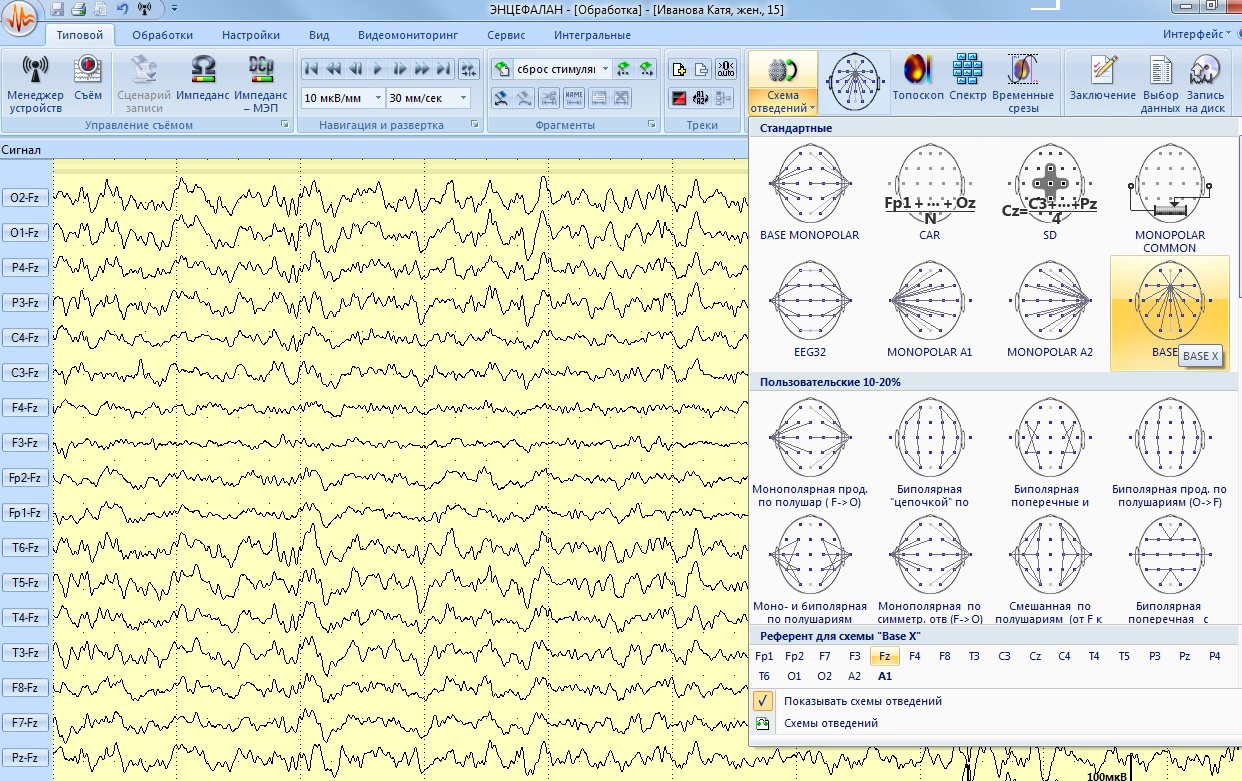 Энцефалан-ЭЭГР-19/26. Модификация Мини - изображение №7