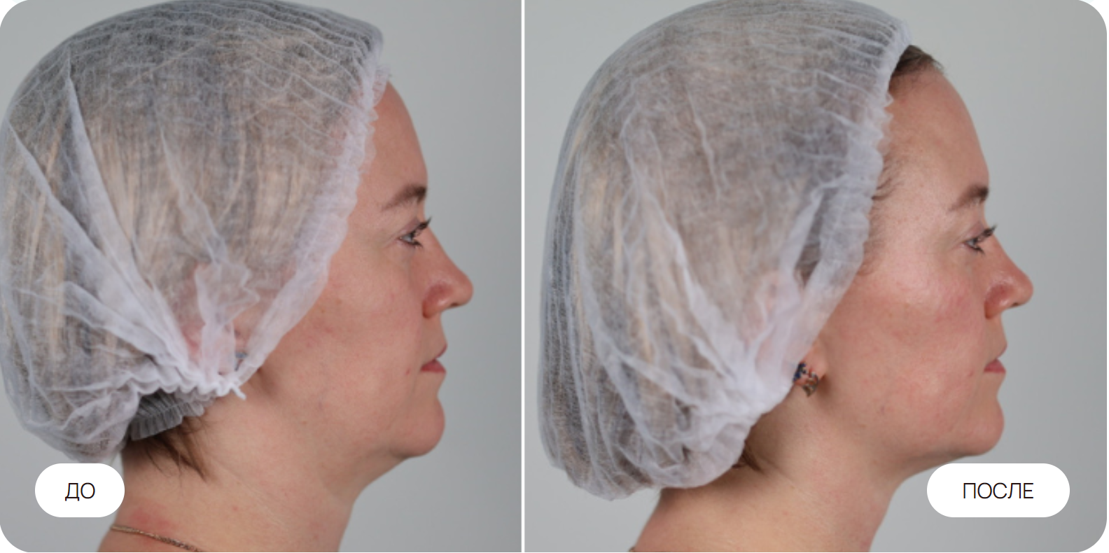 Коррекция второго подбородка. 1 процедура