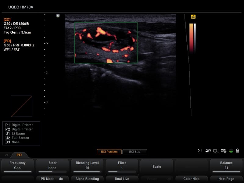 Щитовидная железа, узел, энергетический допплер