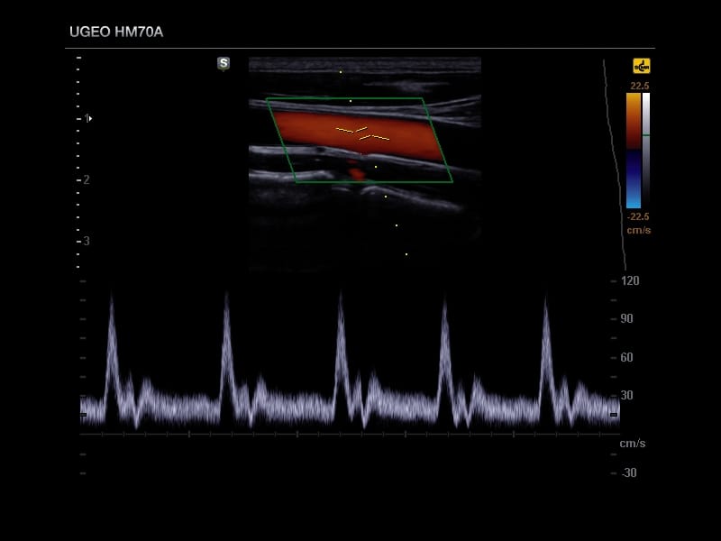 Общая сонная артерия, триплексный режим