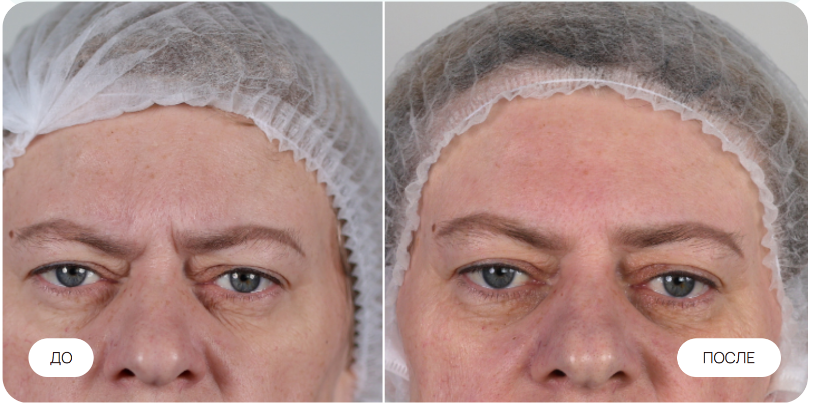 Снятие гипертонуса мимических мышц. 9 процедур