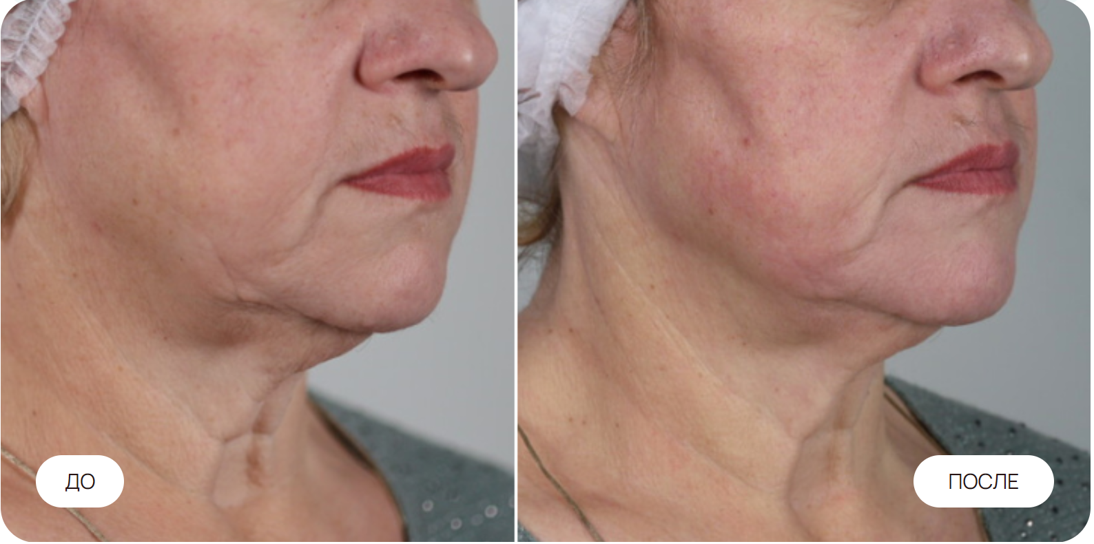 Моделирование овала лица. 4 процедуры