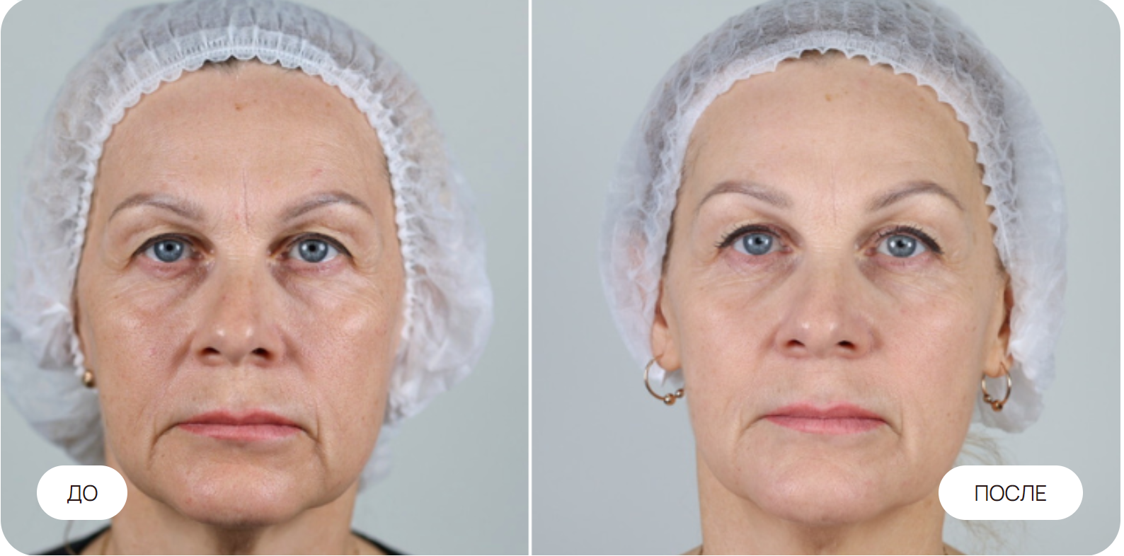 результат после 10 процедур