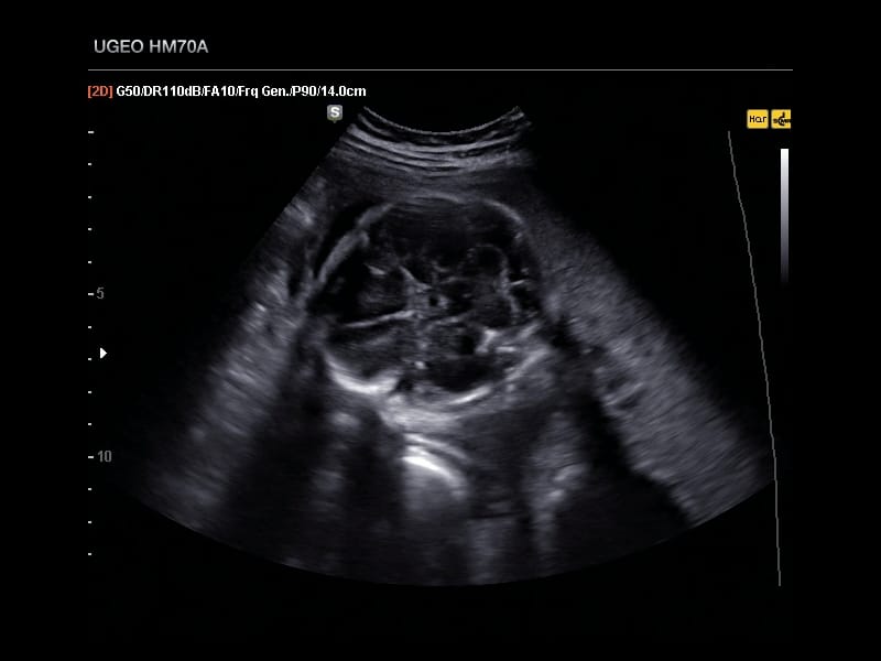 Плод, мозг, Clear Vision