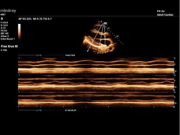 Исследование сердца взрослого анатомический M-режим