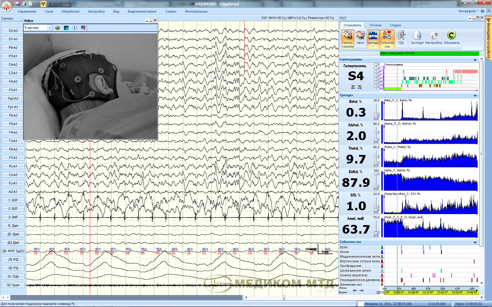 Энцефалан-Видео - изображение №8