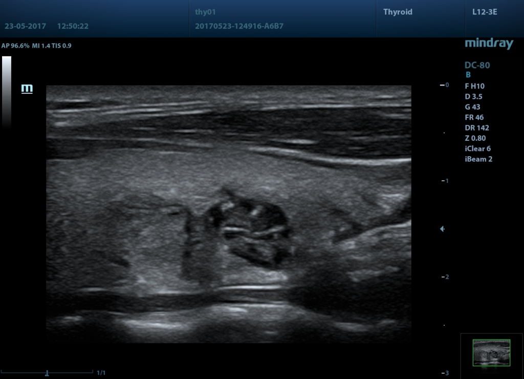 опухоль щитовидки.jpg