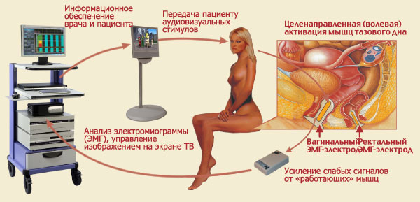 ЛЕЧЕНИЕ НЕДЕРЖАНИЯ МОЧИ У ЖЕНЩИН МЕТОДОМ БОС