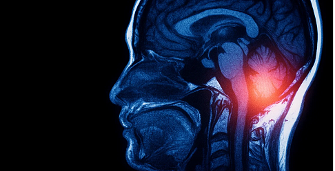 В России разрабатывают новый метод лечения самой агрессивной опухоли мозга