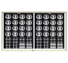 Рентгенология Негатоскоп.Ру двухкадровый